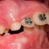 Malocclusione