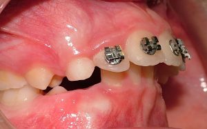 Malocclusione
