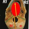 Cranio-Mandibola in Torsione
