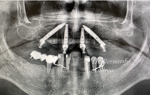 Full Arch by Dr Andrea Bernardis